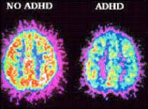 Treatment Of ADHD