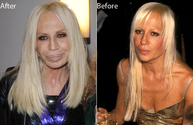 Donatella Versace Plastic Surgery.