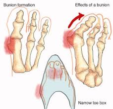 Bump On Pinky Toe From Shoes Bump On Pinky Toe From Shoes
