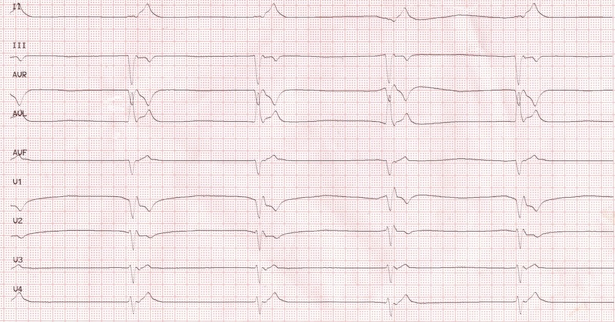 lbbb vs ivcd lbbb vs ivcd