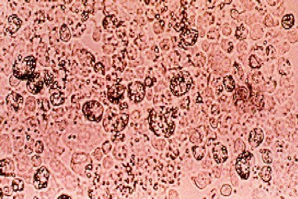 prostatitis por esperma de enterococos faecalis