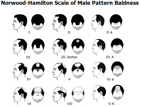 Male Pattern Baldness Chart
