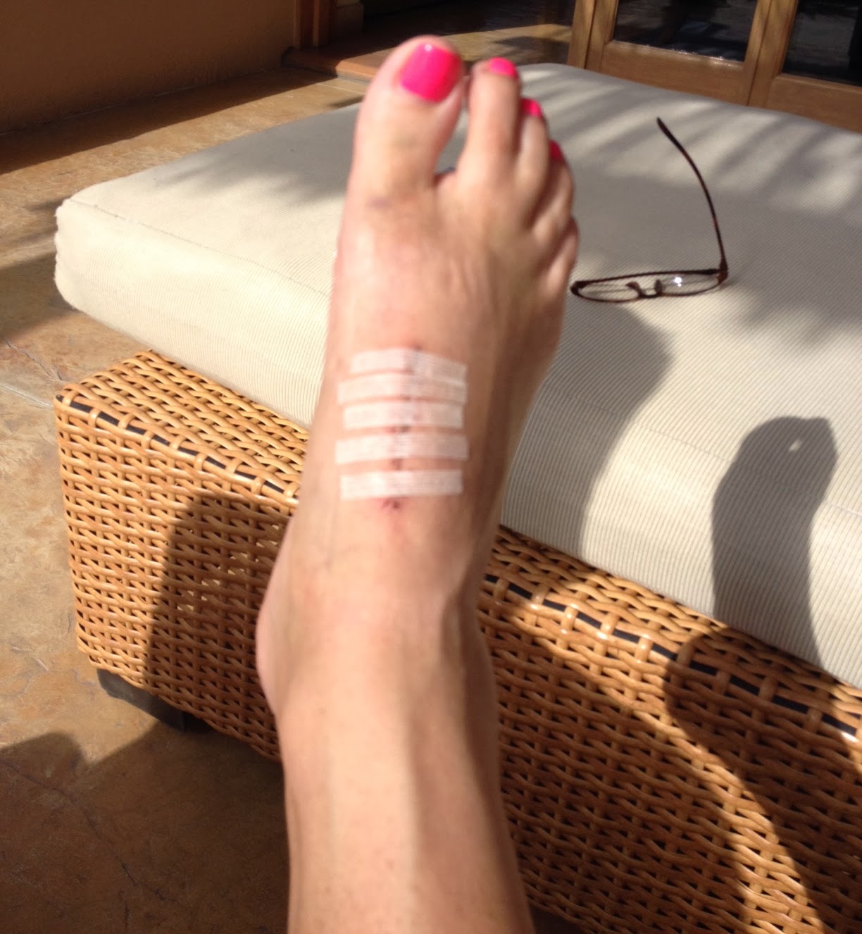 After LisFranc Surgery Removing stitches after lisfranc hardware