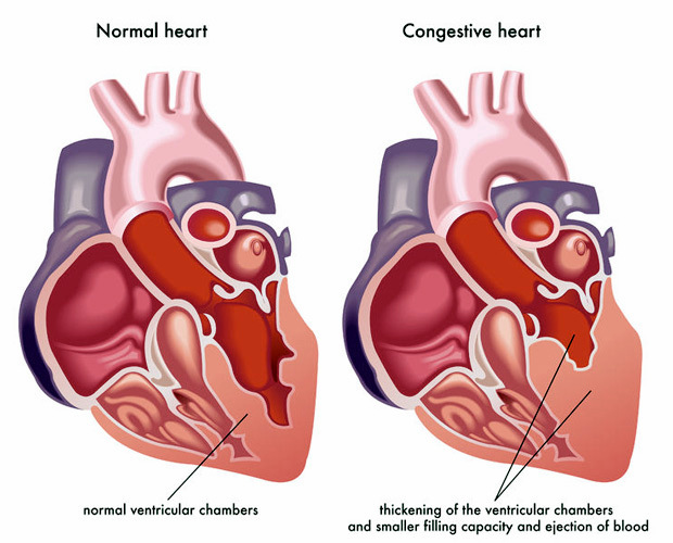 Non Pharmacology Congestive Heart Failure Disease non-pharmacology-congestive-heart-failure-disease