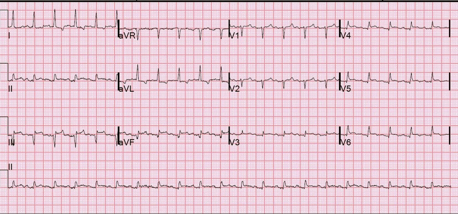 Dr. Smith's ECG Blog Tachycardia must make you doubt an ACS or STEMI