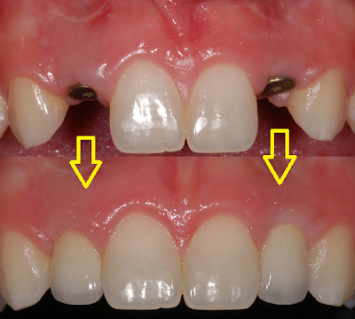Trồng răng giả cố định bằng cấy ghép Implant