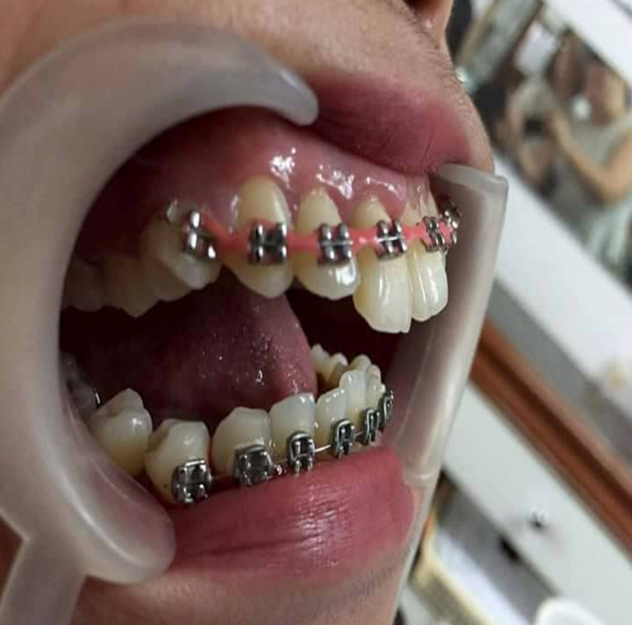 A Woman Whose DIY Dental Braces Terribly Gone Wrong NEWS INFO PHILIPPINES