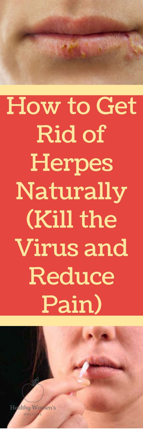 How To Get Rid Of Herpes Virus Permanently