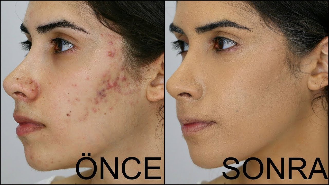 sivilce nasil gecer sivilcelere kesin cozum rehberi tarif dunyasi