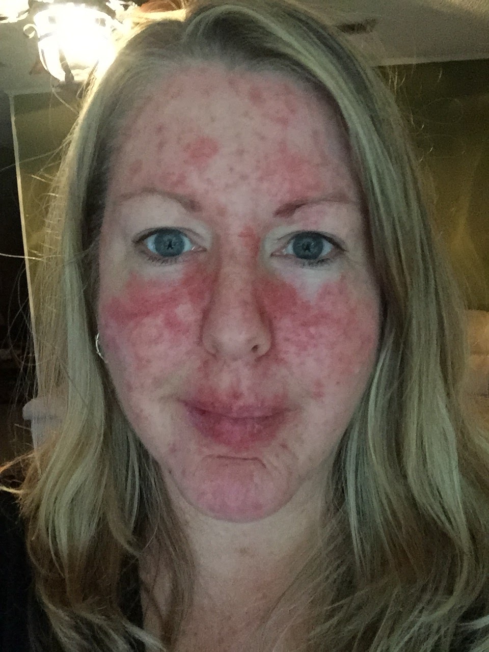 My Journey Through Topical Chemotherapy Fluorouracil 5 Cream and