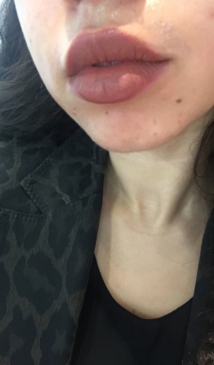 Comfortable in my own skin // how to treat wax burns Blogged by Mays