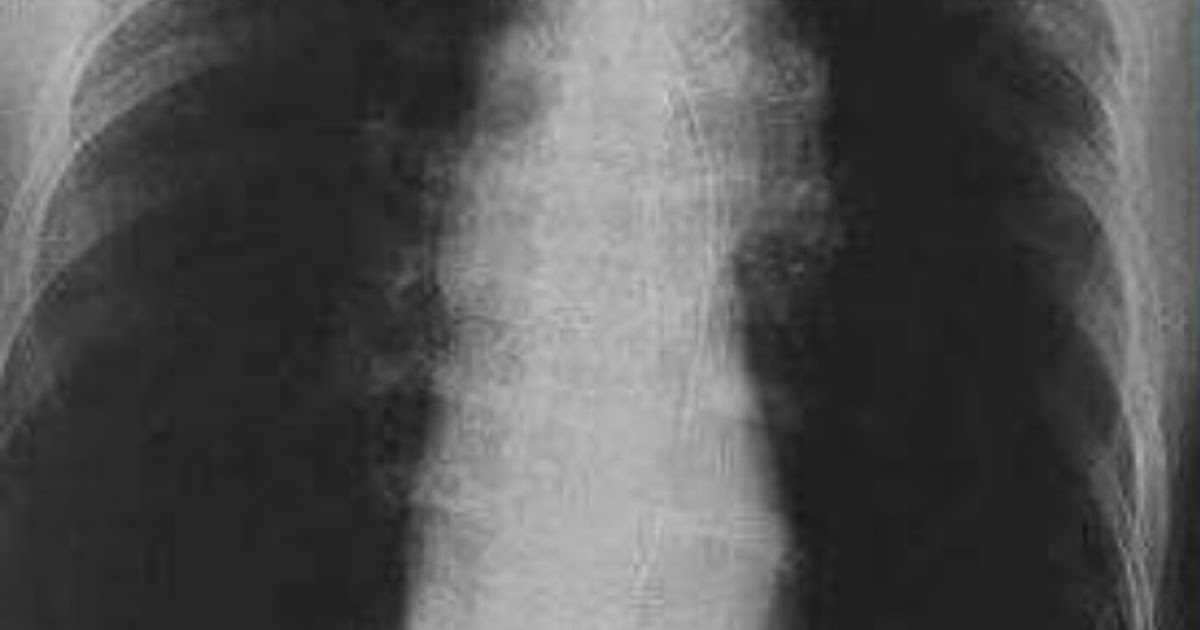 DrRadio EMPHYSEMA Chest xray PA view