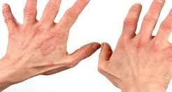 OBAT TRADISIONAL SEMBUHKAN GATAL ALERGI DAN EKSIM DI TANGAN OBAT TRADISIONAL SEMBUHKAN GATAL ALERGI DAN EKSIM DI TANGAN