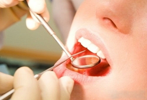 Lấy cao răng mất bao nhiêu thời gian là do yếu tố nào? Lấy cao răng mất bao nhiêu thời gian là do yếu tố nào?