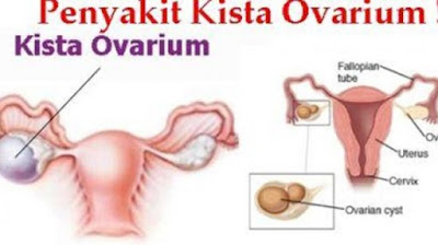 Cara Menghilangkan Kista Ovarium Secara Alami Dan Permanen