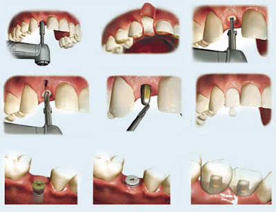 Cấy ghép răng Implant có đau không?