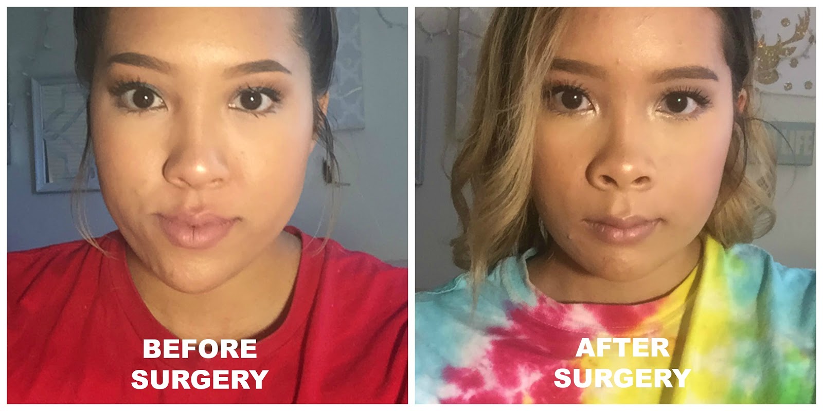 My Double Jaw Surgery Recovery & Experience.