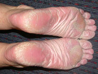 Palmas y pustular de plantas psoriasis