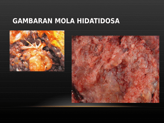Waspadai Penyakit Mola Hidatidosa yang Sebabkan Bayi Cacat Lahir Bahkan Meninggal Dalam Kandungan