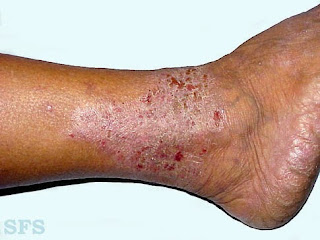 Image Gatal eksim kering pada kaki