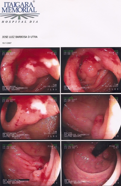 La colonoscopia que demuestra la enfermedad de Crohn antes de la autohemoterapia