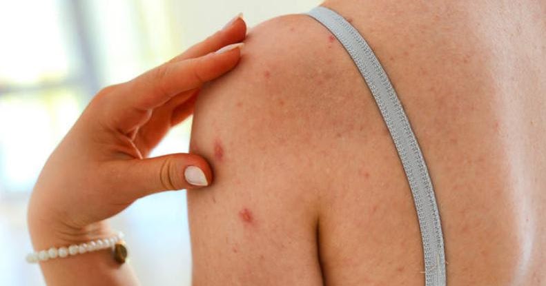 What Causes Shingles To Activate Socahealth
