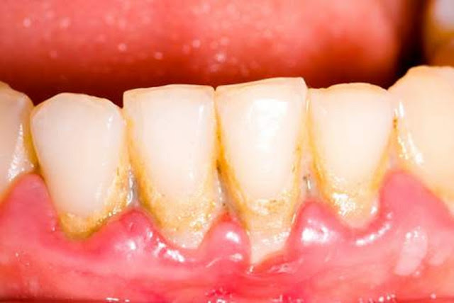 Milagro enjuague su boca solo 1 minuto con esto y elimina el sarro y la placa acumulada de los dientes para siempre.! Milagro enjuague su boca solo 1 minuto con esto y elimina el sarro y la placa acumulada de los dientes para siempre.!