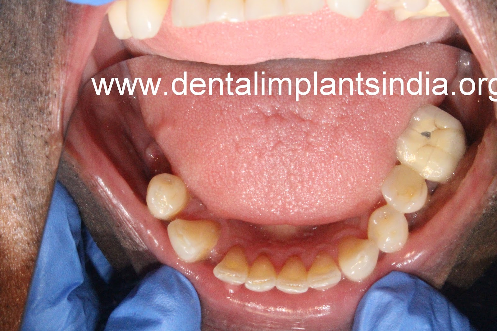 Chinthamani Laser Dental Clinic Quality Dental Implants in Chennai, India