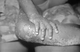 Monkeypox Monkeypox