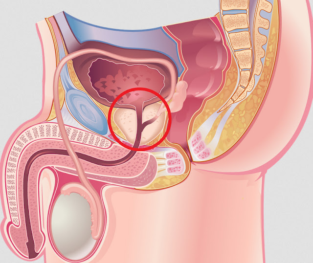 Natural Remedies For enlarged Prostate Natural Remedies For enlarged Prostate