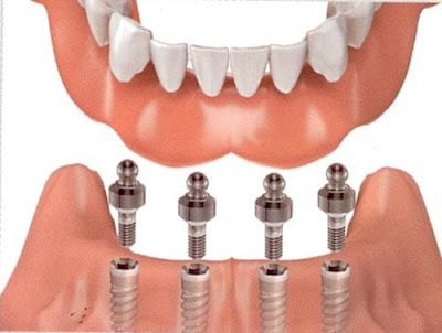 Cắm ghép Implant phục hồi nhiều răng đã mất