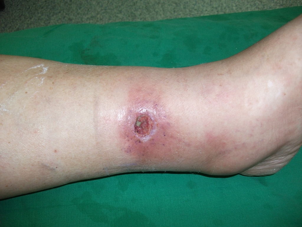 stadiul iniial al piciorului varicose)