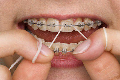 Chi phí niềng răng phụ thuộc vào những yếu tố nào?