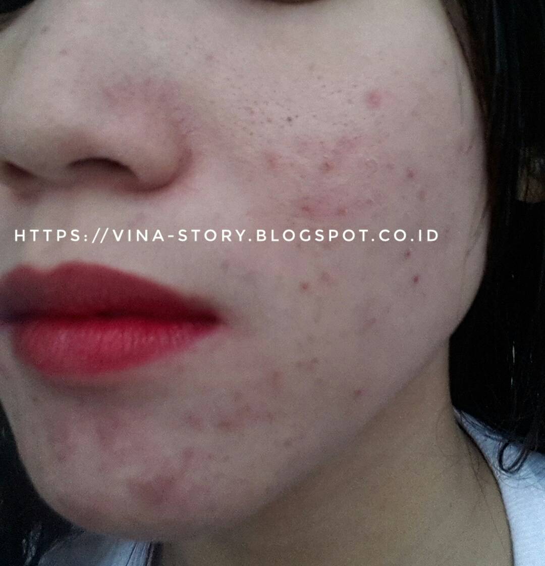Mommies Beauties Journal Pengalaman Lepas Krim Dokter Atau Perawatan Di Dokter Spkk Breakout Trial Error Purging Acne Fight Survive Part 1