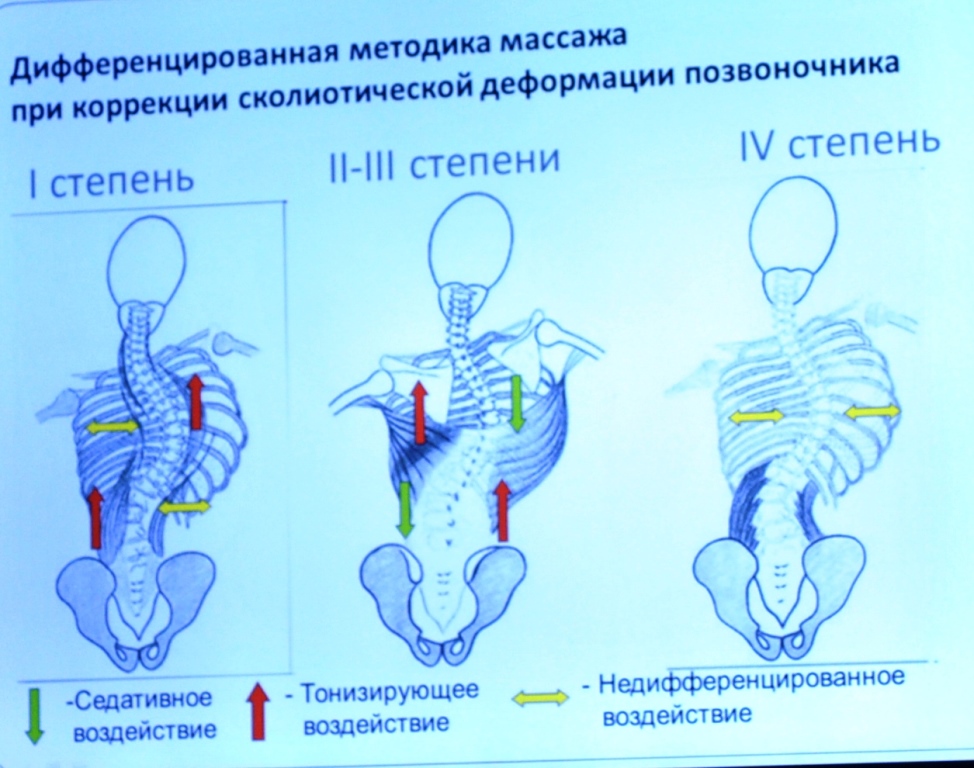 Сколиоз 1 степени спорт