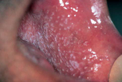 Oral lichen planus Treatment - Mayo Clinic