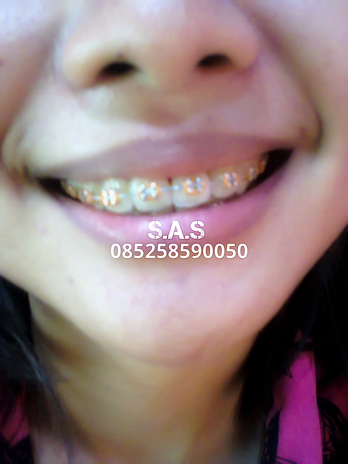 Koleksi Foto Senyum Behel Cantik dan Model Warna Karet