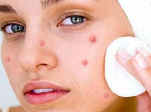 15 Arti Jerawat Cinta Di Atas Bibir Menurut Primbon Dan Psikologi Terlengkap Arti Jerawat Pipi