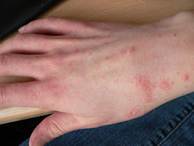 Post scabies syndrome image