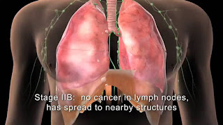 स्तन कैंसर का कारण बनता है, ब्रेस्ट कैंसर के कारण, ब्रेस्ट कैंसर का इलाज, ब्रेस्ट कैंसर कैसे होता है, ब्रेस्ट में दर्द, ब्रेस्ट में गांठ, सिम्पटम्स ऑफ़ ब्रैस्ट कैंसर, ब्रैस्ट कैंसर स्टेजेस, ब्रेस्ट कैंसर स्टेजेस