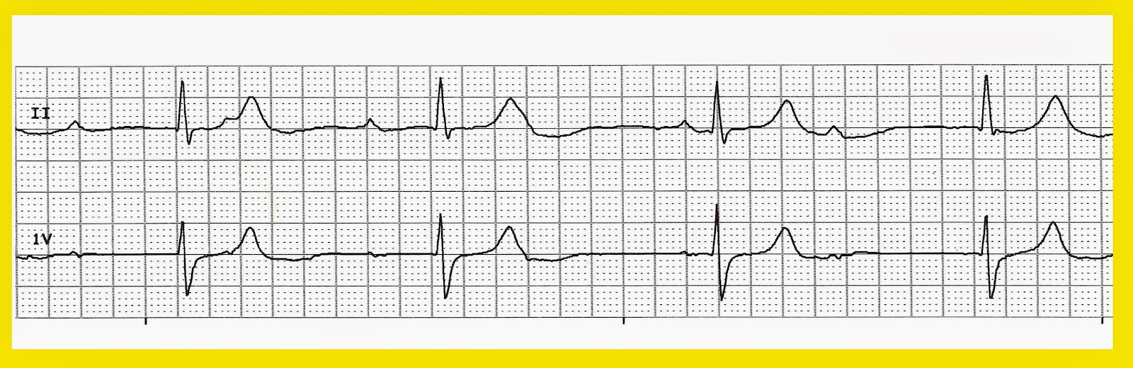 Ecg Examples Of Heart Blocks