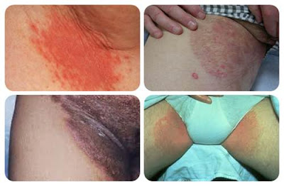 Image Menghilangkan gatal gatal diselakangan-Obat eksim diselakangan