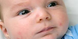  What does baby acne appear like