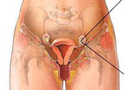 Gejala Kanker Ovarium Pada Wanita
