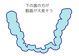 抜歯ワイヤー矯正患者が思う「マウスピース矯正」について