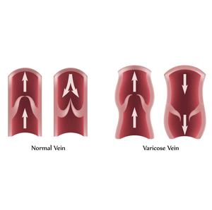 Gejala Varikokel  Testis Grade 1 2 dan 3 Klinik Holistik 