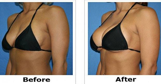 breast enlargement capsule in india aboutherbal com is breast size hereditary