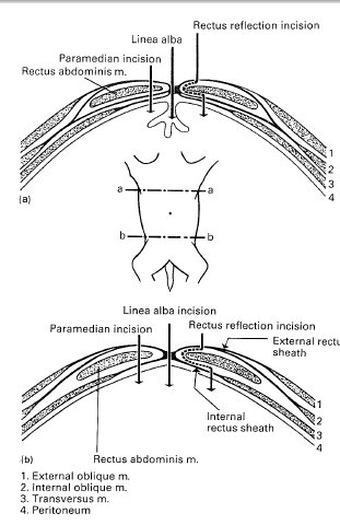 laparoscopia unei mici varicoase pelvine exerciii medicale pentru picior varicoza