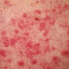 11+ Arti Mimpi Badan Penuh Bintik Merah