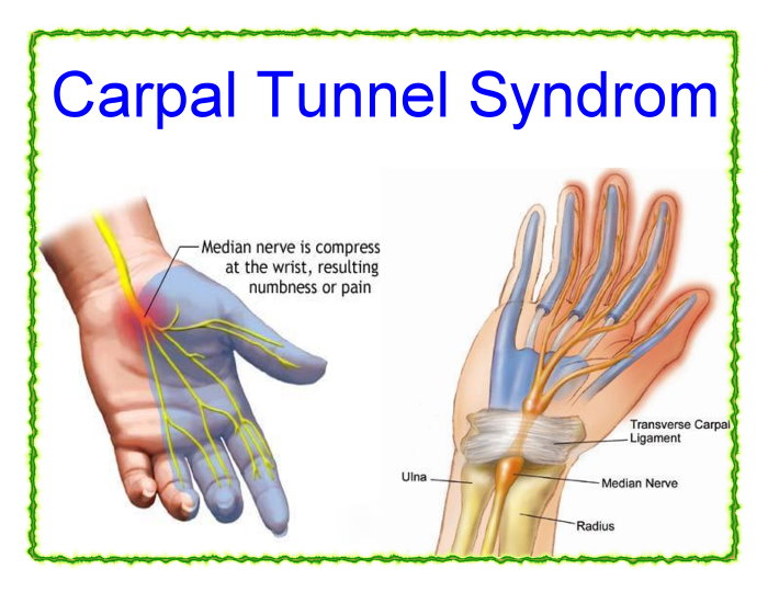 Carpal tunnel syndrom